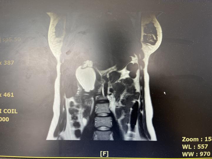 小儿胆总管囊肿开刀手术,腹腔镜胆总管结石手术打孔位置