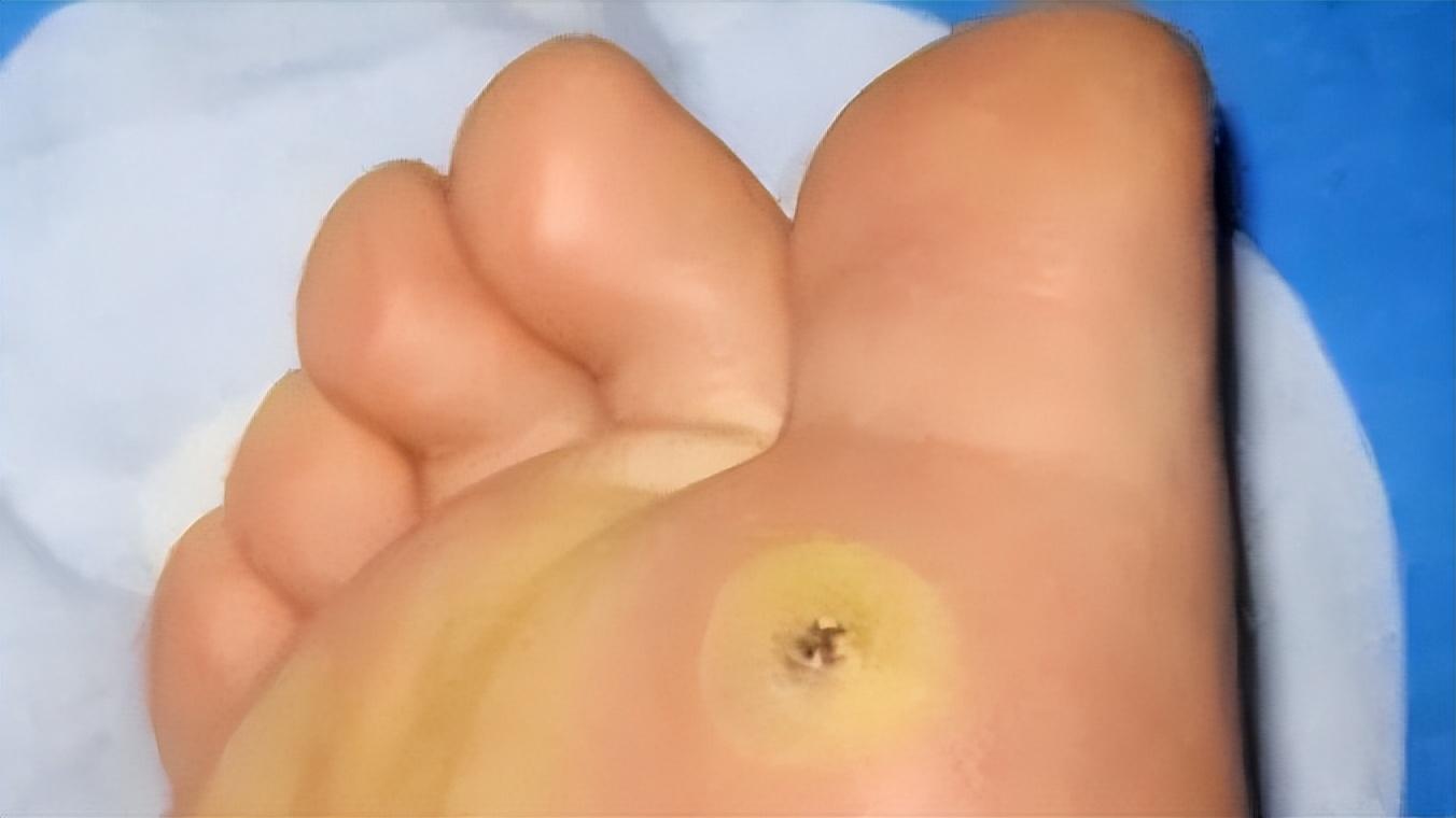 脚底板爱发烫是什么原因,脚底板生茧很疼怎么回事