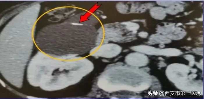 肾囊肿跟肿瘤有什么区别,囊肿在检查过程中破了会怎样