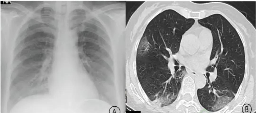 阳康后背上长痘,阳康后后背长疹子
