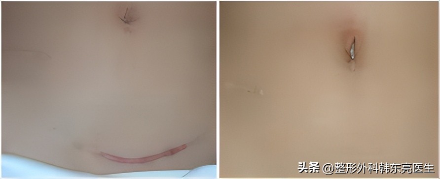 修复凹陷疤痕的最好方法,额头疤痕修复最佳方法