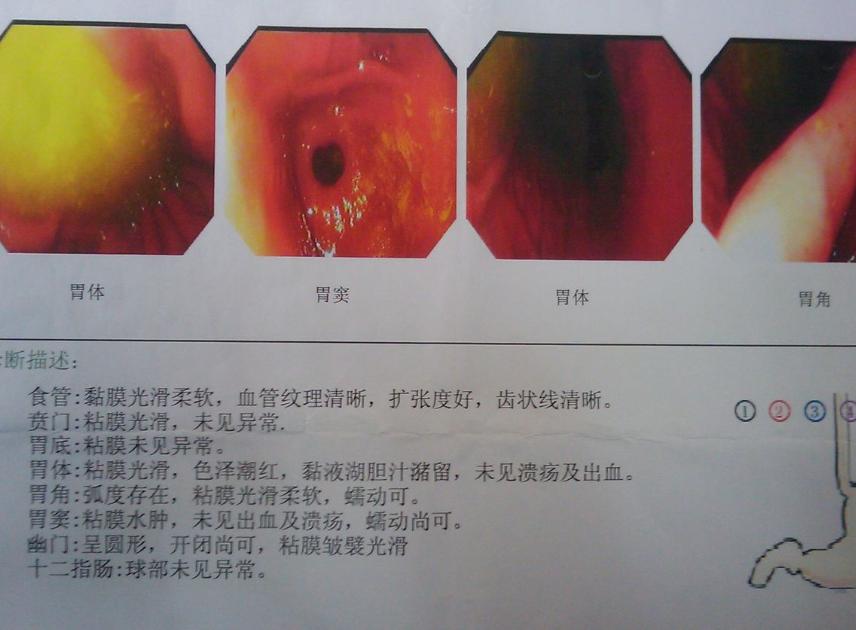 长期服用奥美拉唑要注意以下几点,奥美拉唑是毒药吗