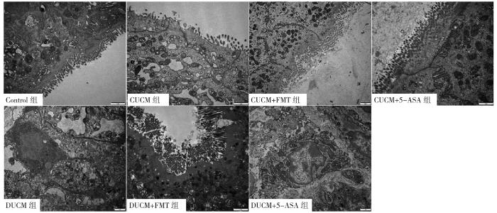 粪菌移植对溃疡性结肠炎的保护,粪菌移植治疗溃疡性结肠炎靠谱吗