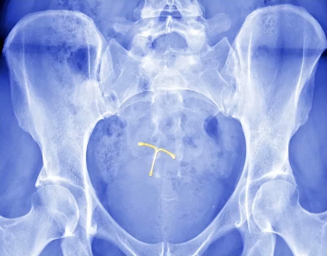 女性上环过程是怎样的,女性上环的全流程