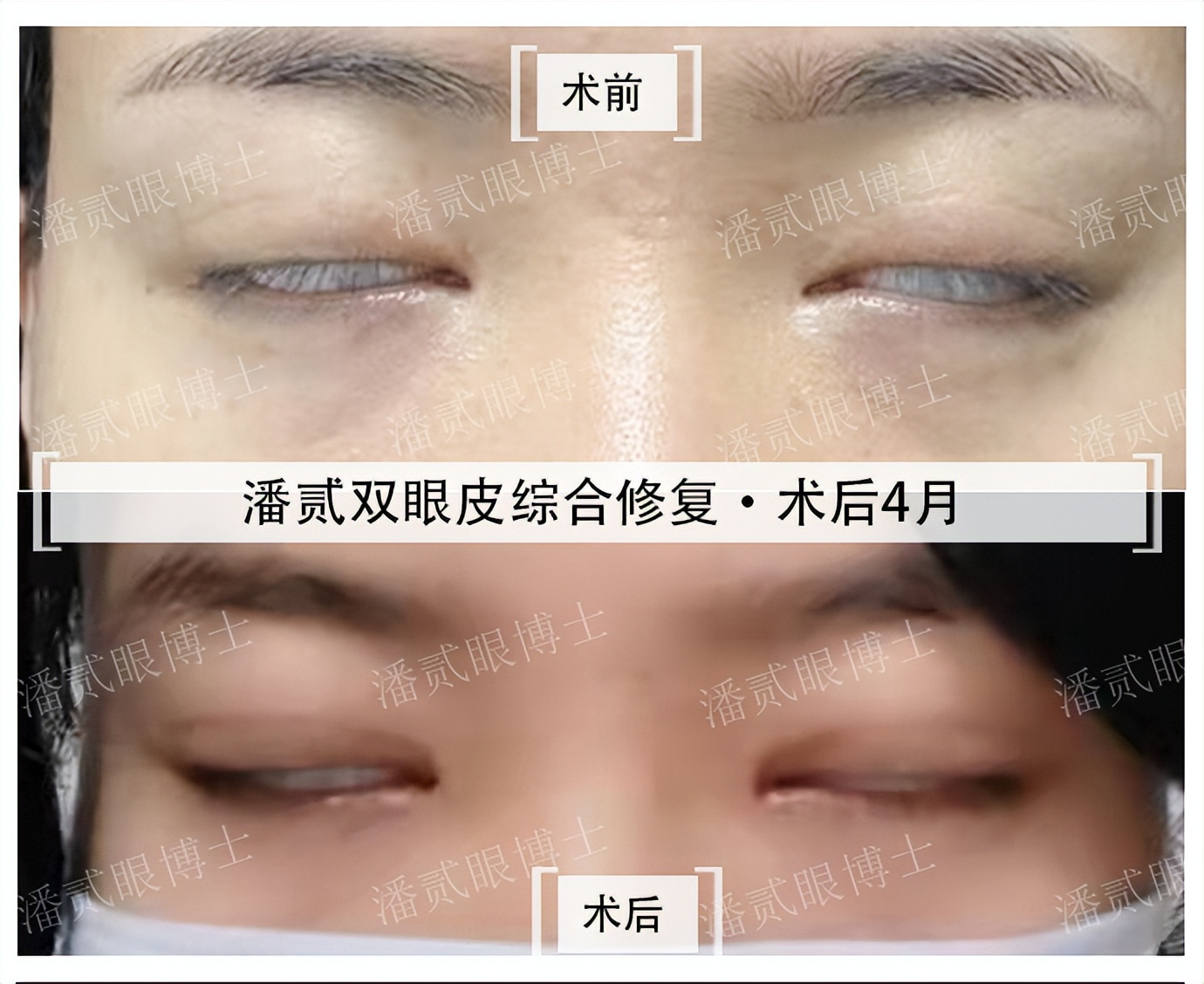 整容后眼睛不能闭合,整容失败眼睛无法闭合