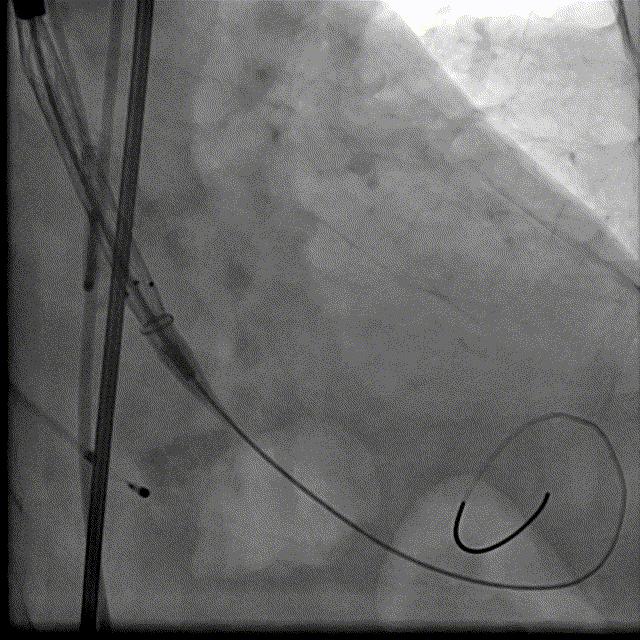 主动脉瓣狭窄病例讨论,25岁主动脉瓣狭窄用什么治疗方案