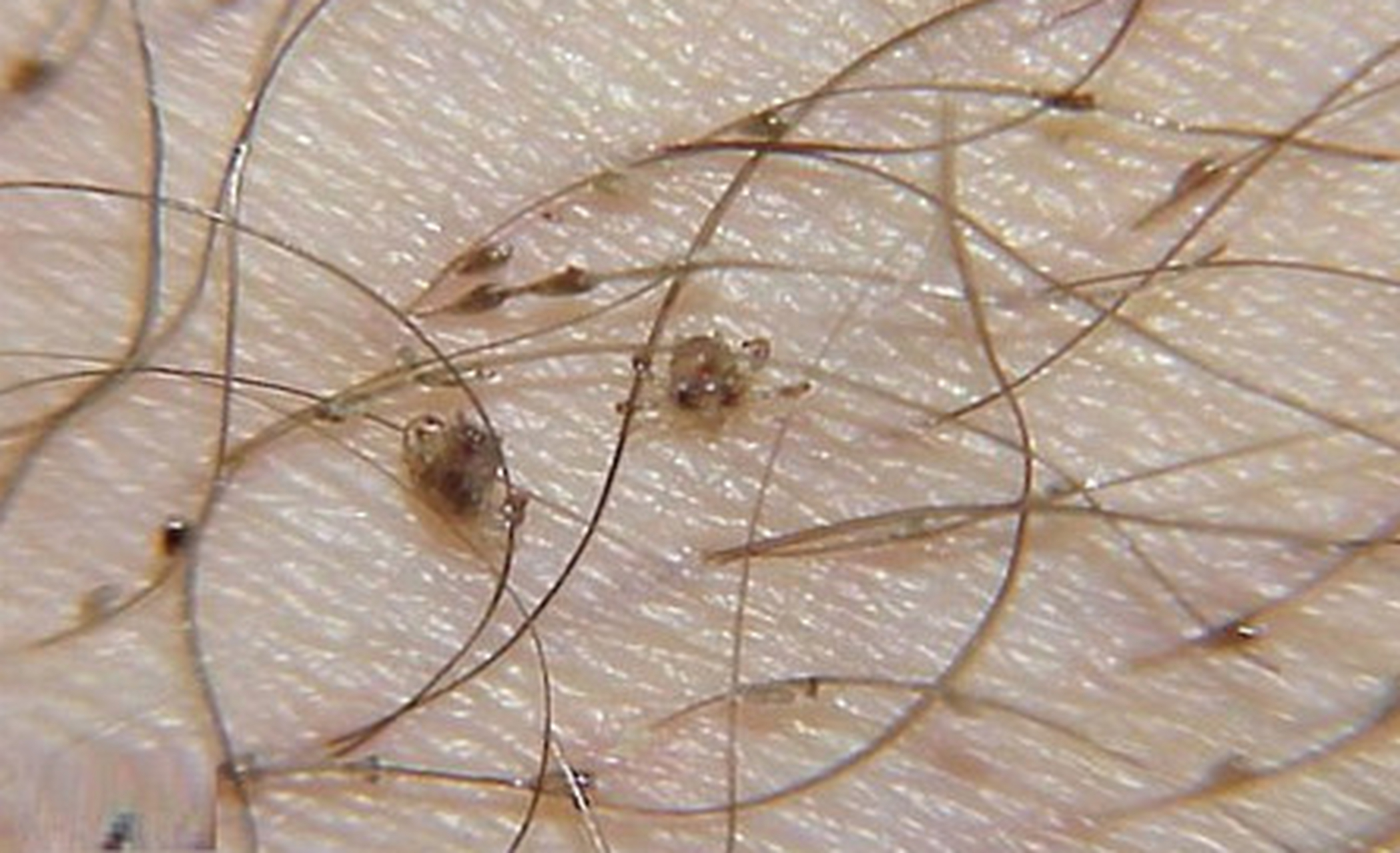 阴虱是什么原因得的知乎,阴虱为啥会出现