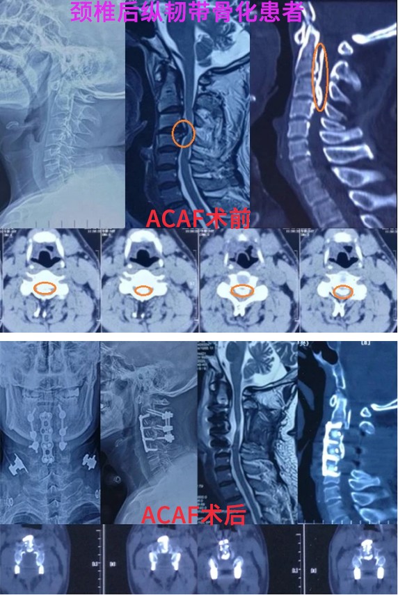 颈椎后韧带骨化是哪种颈椎病,颈椎后纵韧带骨化怎么回事