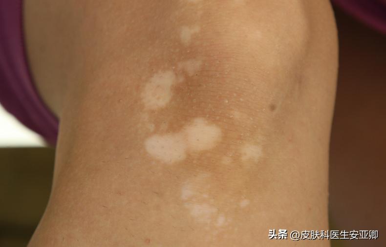 银屑病和白癜风用的光疗有区别吗,白癜风治疗308准分子光好使吗