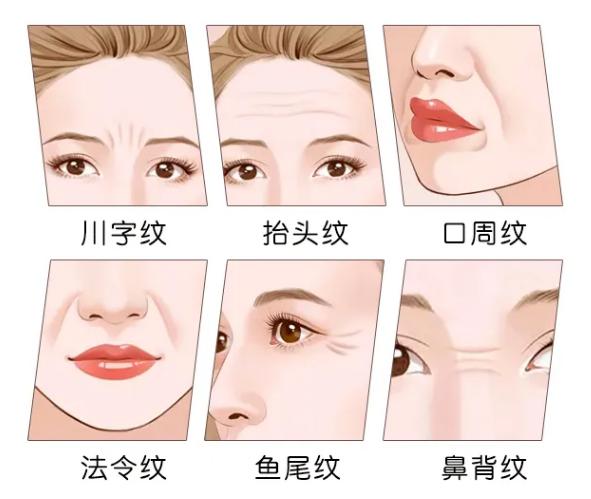 表情纹和静态纹怎么区别,动态纹和静态纹的祛皱区别