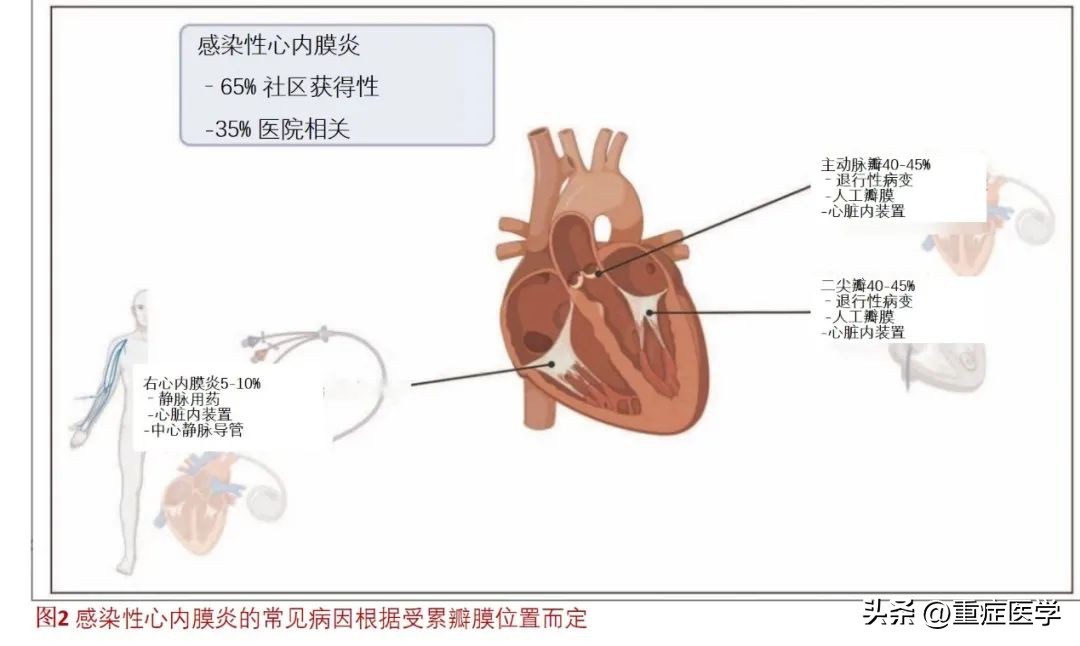 ICU心内膜炎新进展