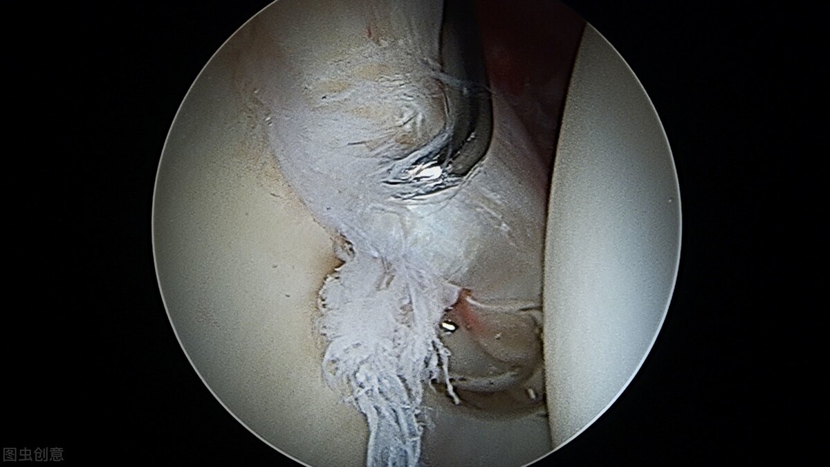 髋关节盂唇撞击撕裂可以评残吗,髋关节盂唇损伤就是撞击综合征吗