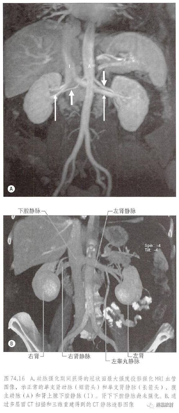输尿管和髂血管解剖,脾胰解剖图