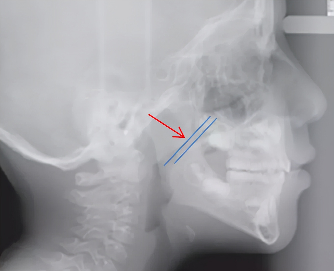 小孩张嘴睡觉腺样体肥大图片,孩子睡觉张嘴呼吸腺样体肥大图片