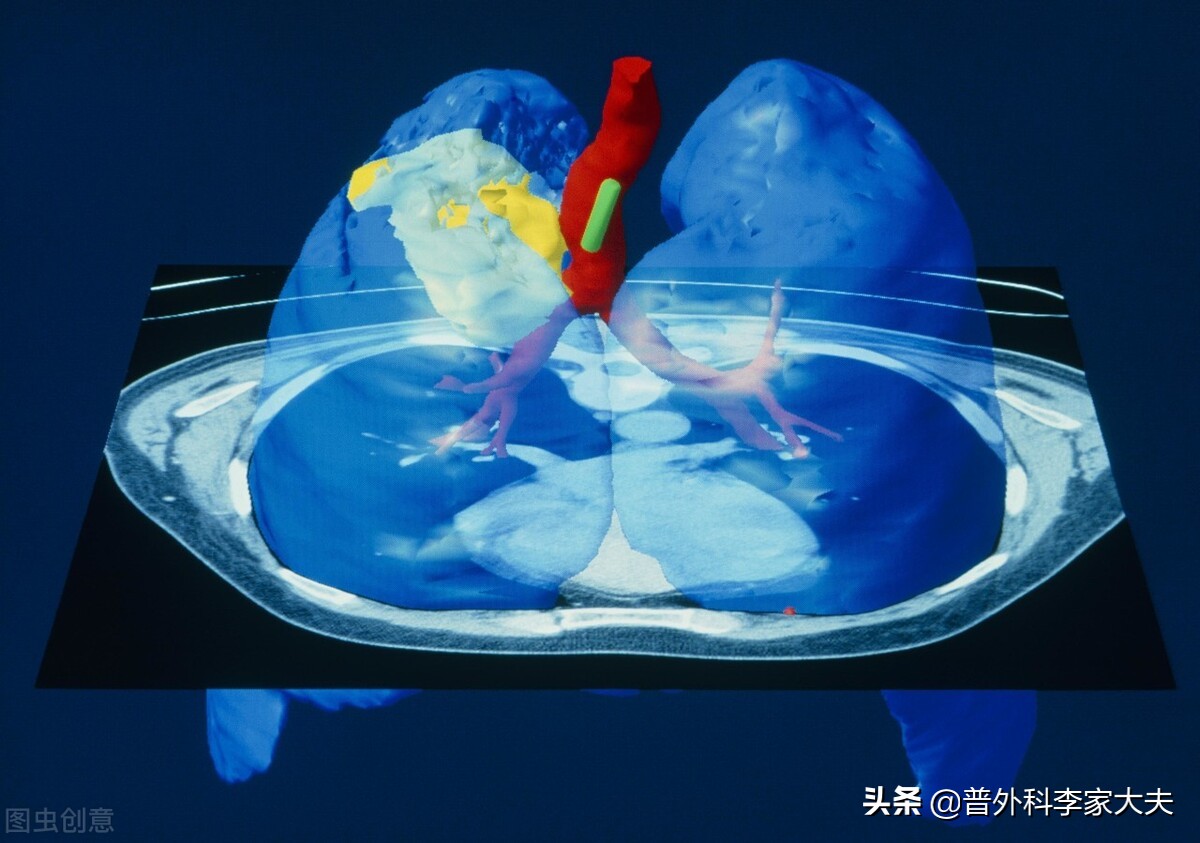 肺腺癌Ⅱb期的郭某是如何抗癌成功的？