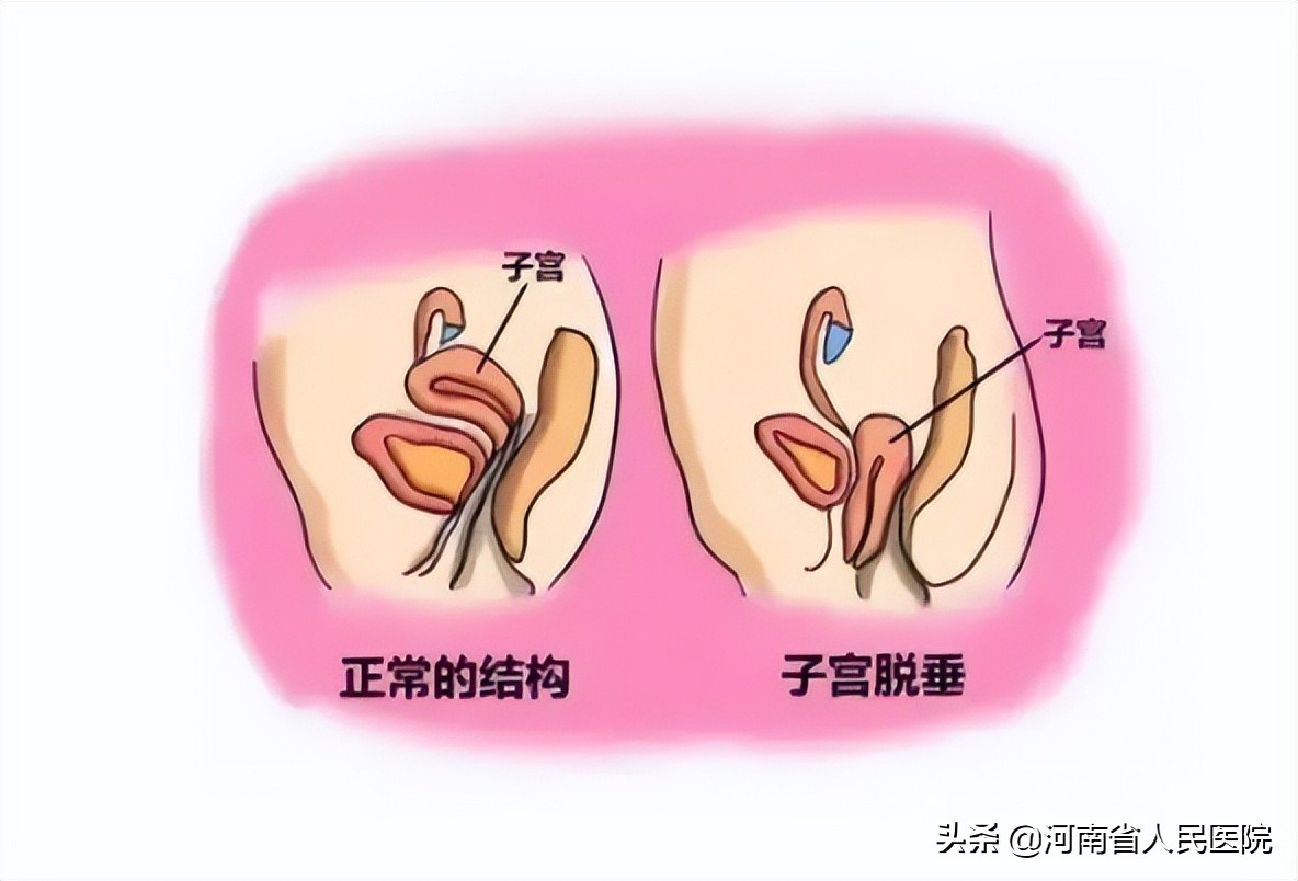 比起更年期，这种女性“难言之痛”，更揪心