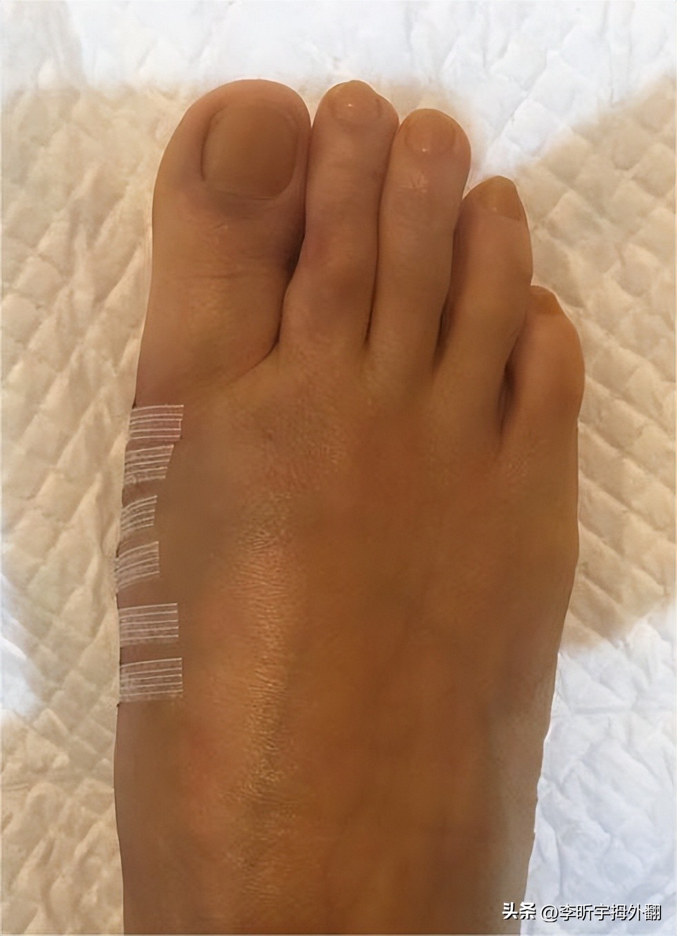 拇外翻术后骨头愈合强度,拇外翻术后伤口开裂