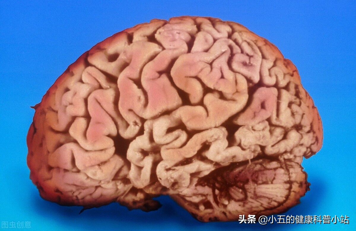 老年人脑萎缩有什么好的治疗方法,老人脑萎缩怎么办三种办法助恢复