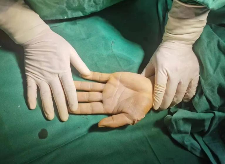 真人蟹钳型六指手术全过程,六指蟹钳切除手术哪家医院靠谱