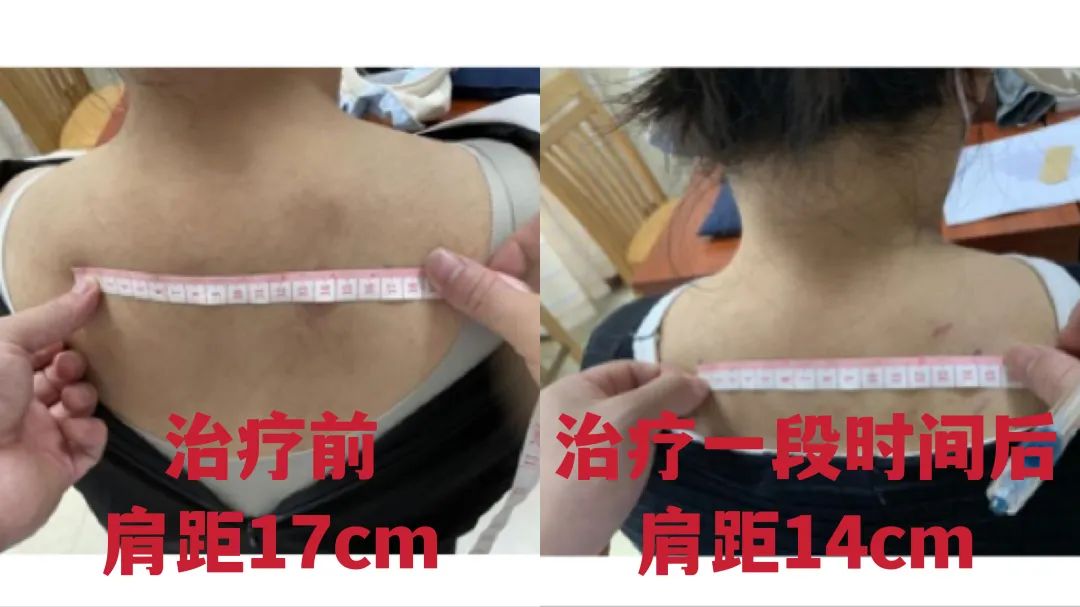 崴脚、富贵包、腰痛这些都可以去一个科一针搞定