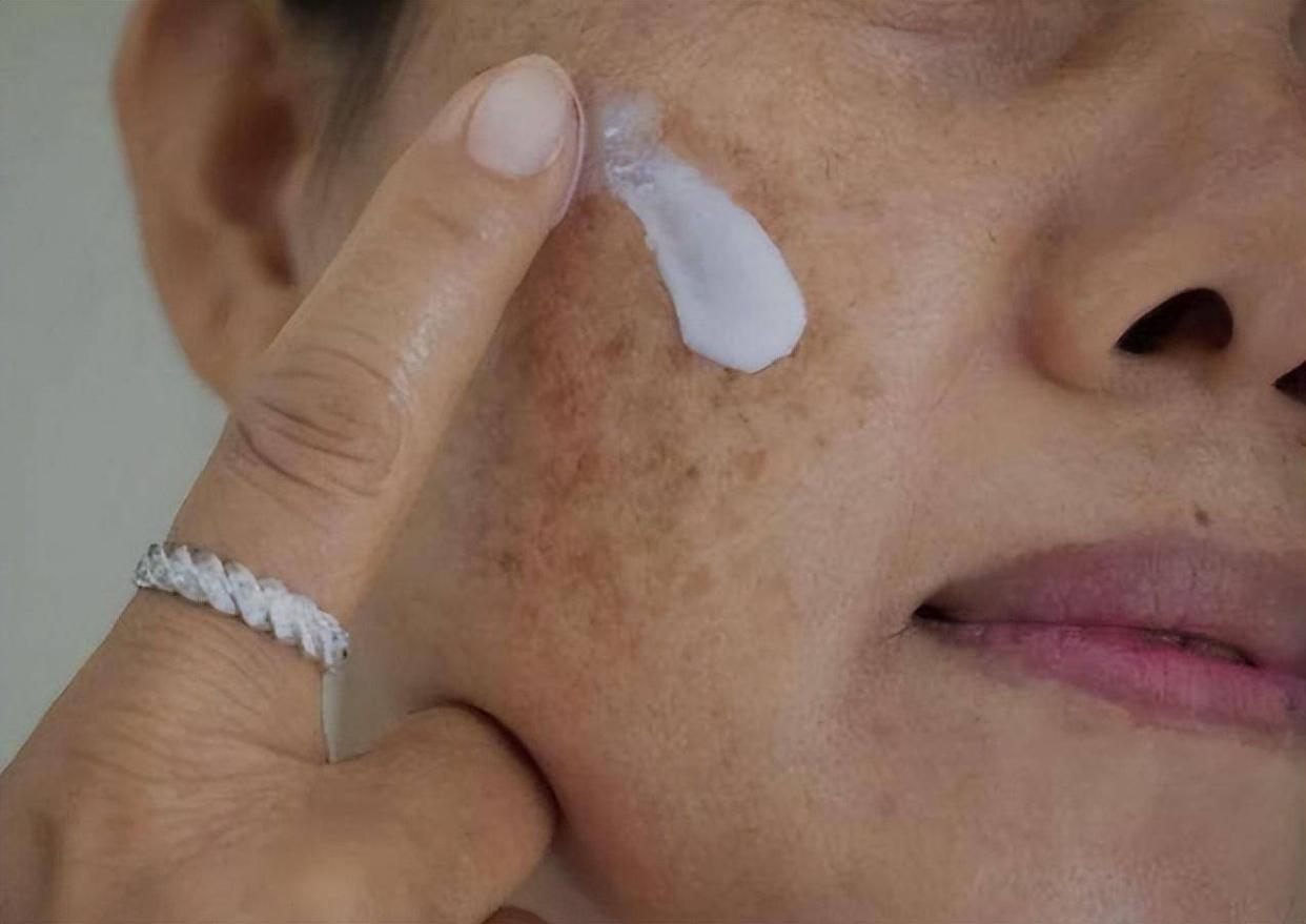 老年斑用红霉素软膏可以除掉吗,用红霉素眼药膏去除老年斑有效吗