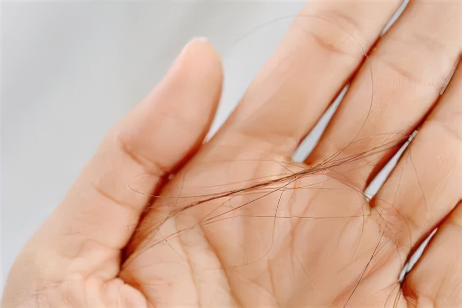 植发生意究竟有多暴利,植发暴不暴利