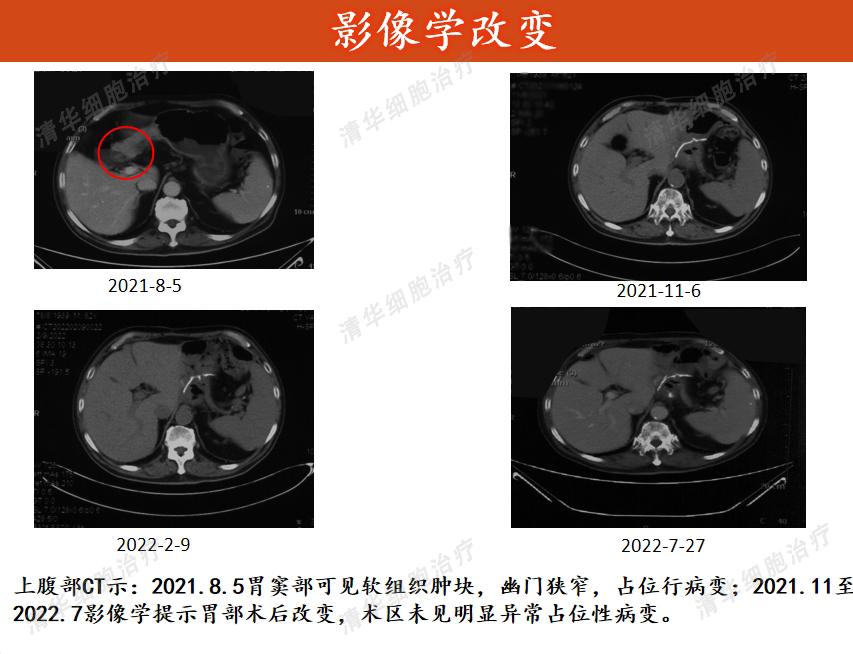 83岁高龄患印戒细胞癌，是细胞治疗让他多一个治疗手段