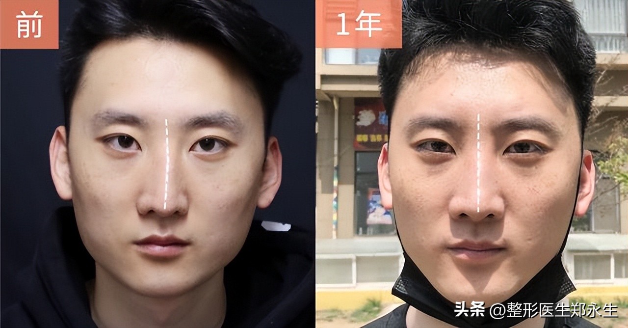 鼻子歪了怎么矫正,鼻子歪了矫正后呼吸会好吗