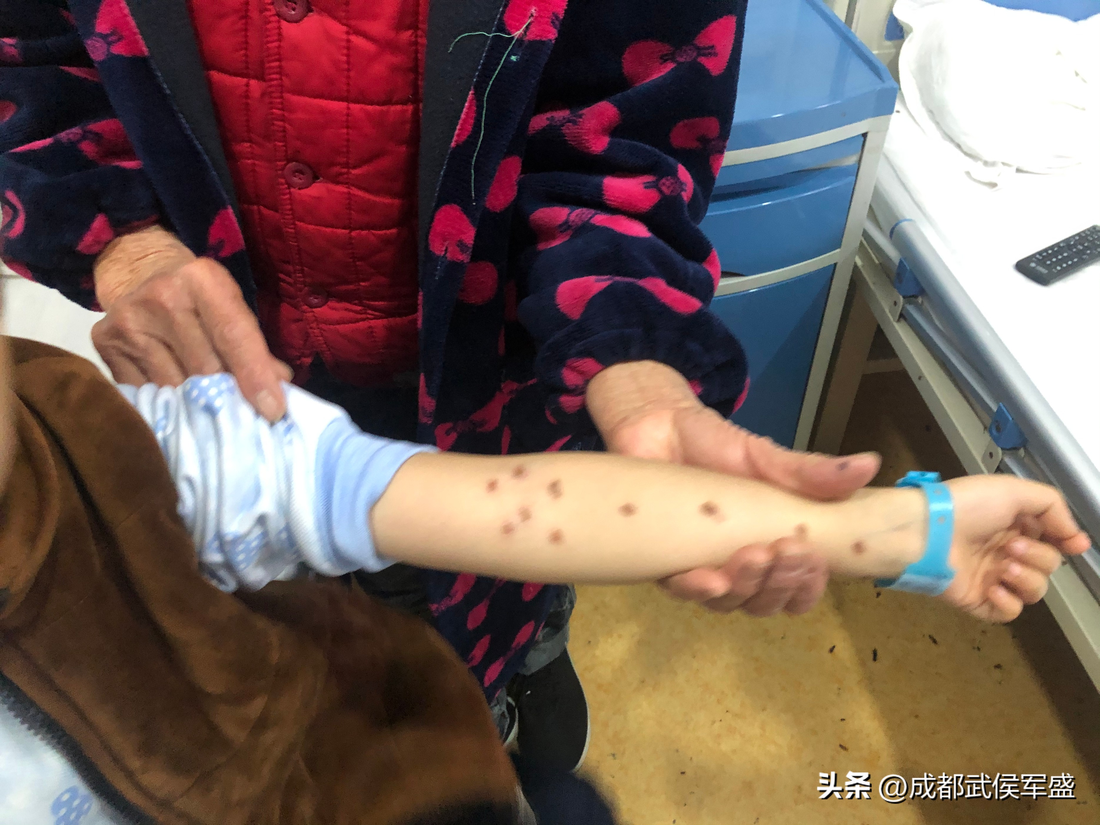 6岁男童被父亲烟头烫,癫痫发作被火烫伤的男孩