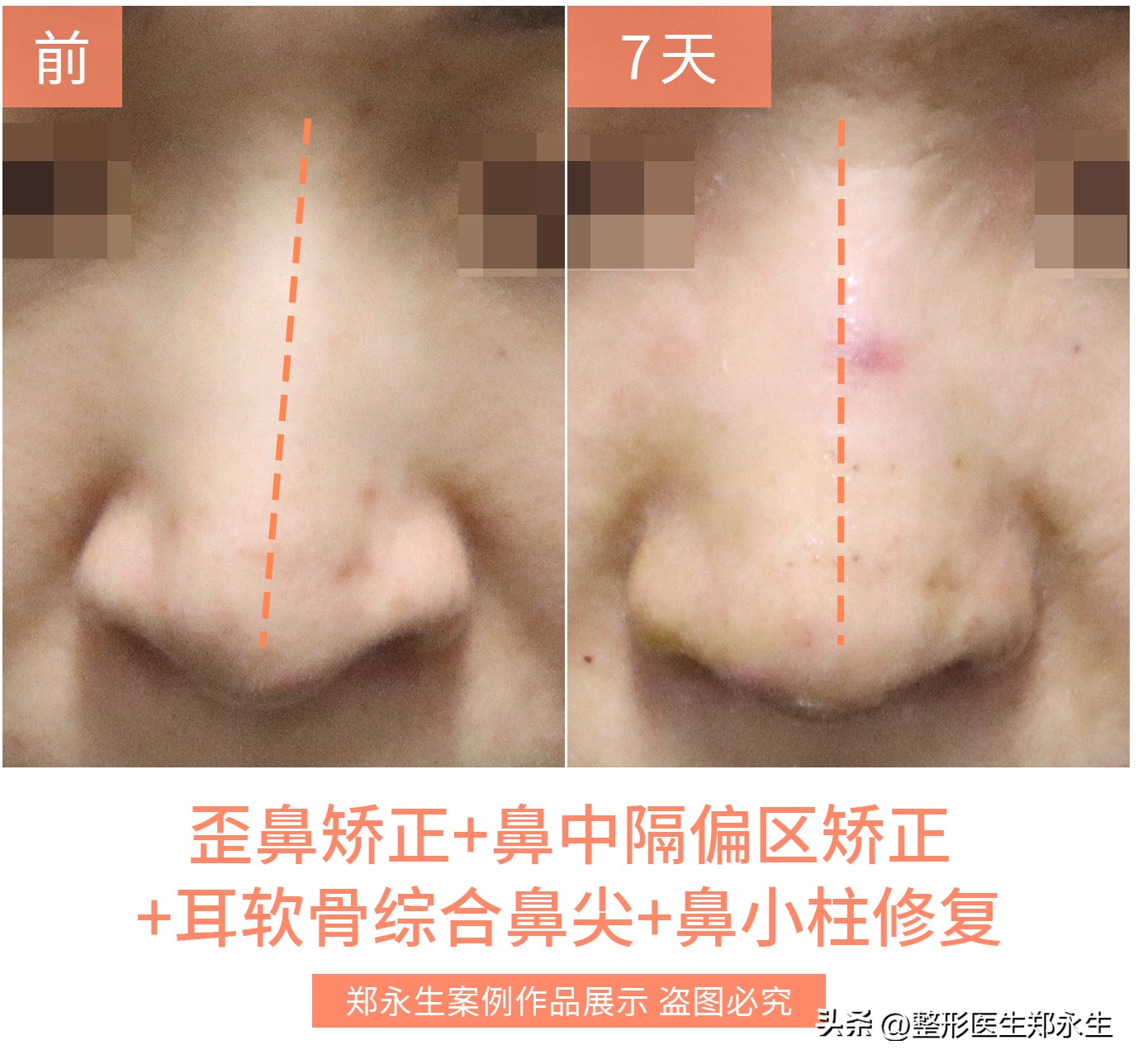 歪鼻是什么原因引起的,歪鼻歪鼻