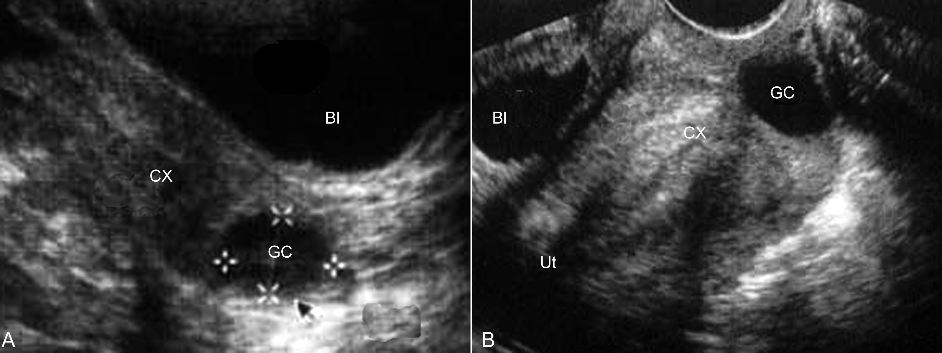 明明白白做超声33-11：妊娠合并盆腔其他异常