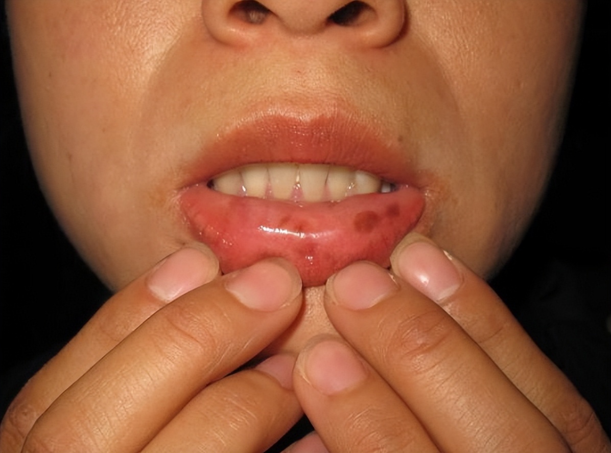 体内有癌三处变黑,体内有癌可能有3处变黑