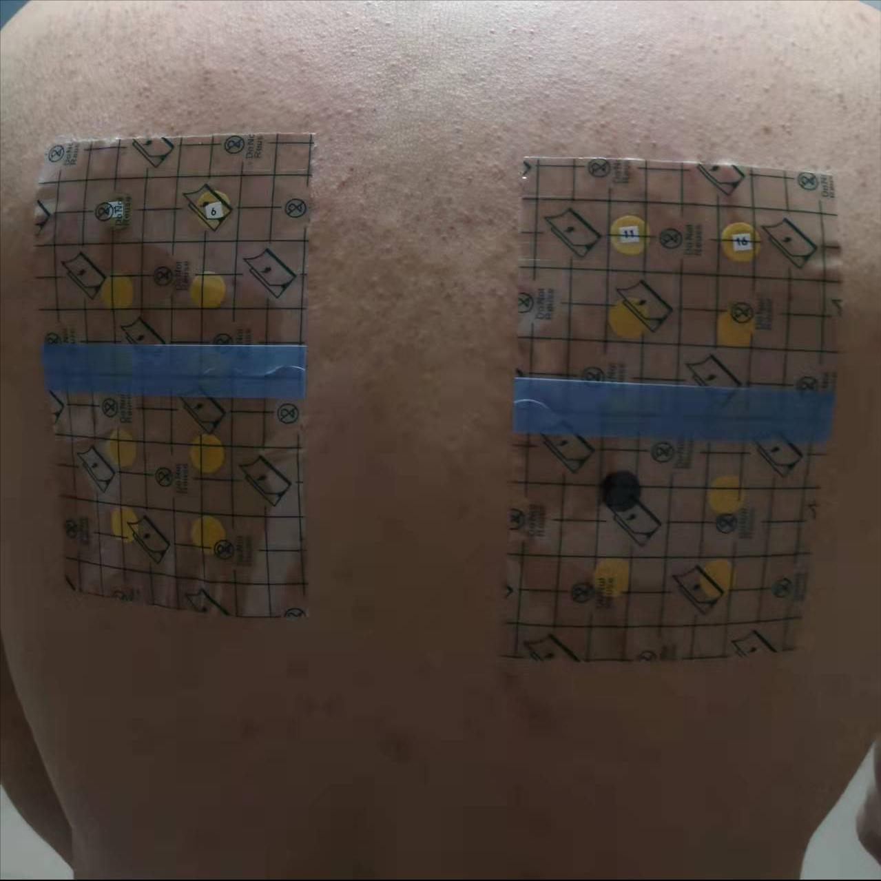 对镍过敏是怎么回事,镍过敏的人多不多