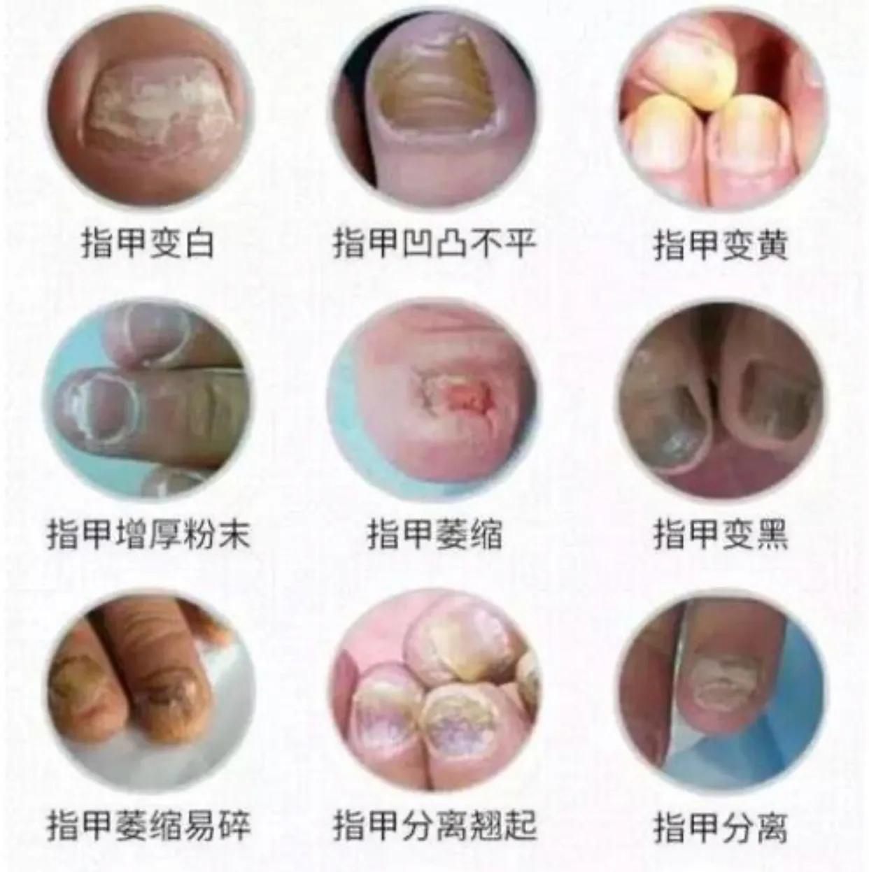 广东广州：一女子做完美甲后，发现指甲里面总是有黑黑的东西。