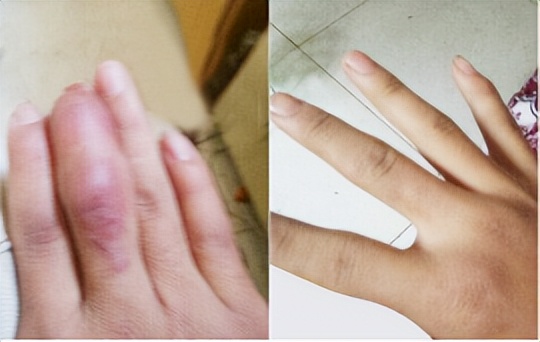 冻伤疤痕怎么治疗效果最好,冻伤疤痕40多年能恢复吗