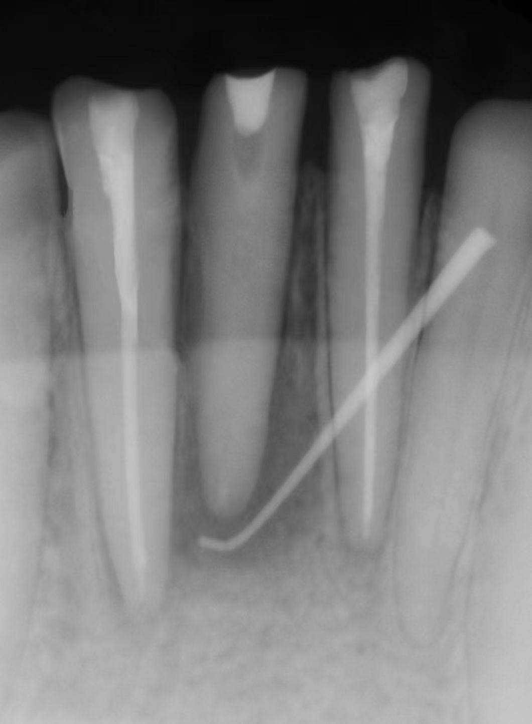 口腔牙龈内壁长硬包是上火吗,牙龈肿痛上火有个脓包怎么办