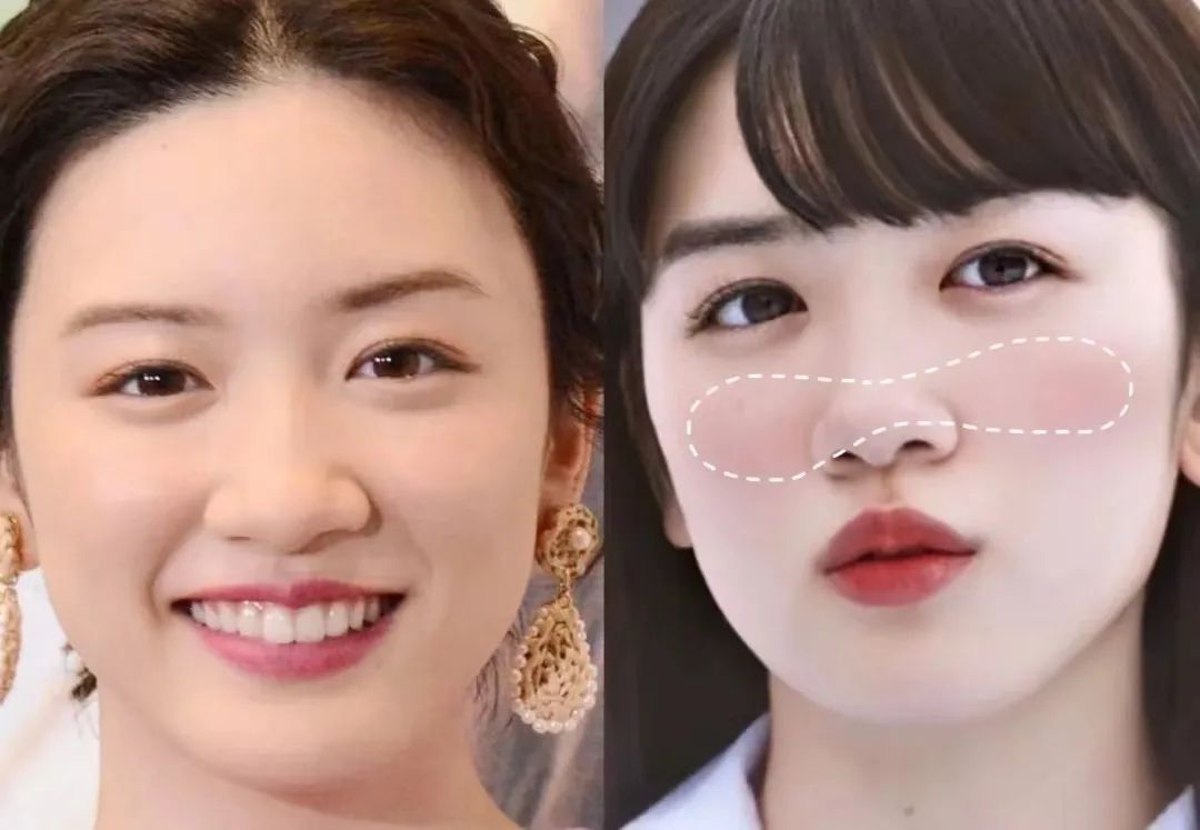 塌鼻子正脸好看,塌鼻子该如何变美啊