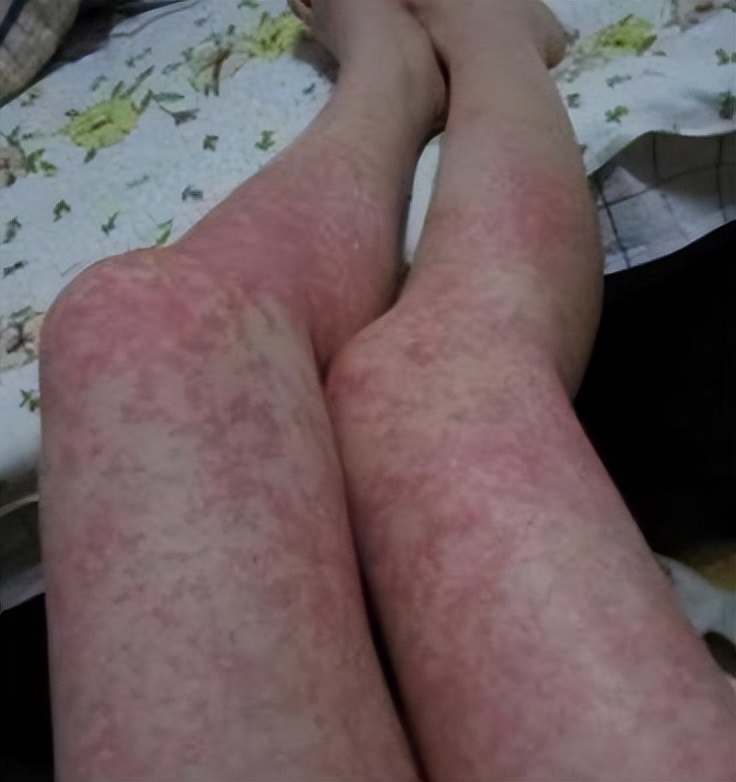 紫癜最忌口食物一览表,紫癜初期小血点图片