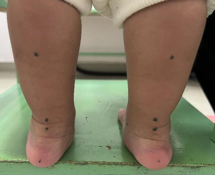 1岁宝宝不愿走路总是要爬怎么办,2岁宝宝一只脚扁平足怎么办