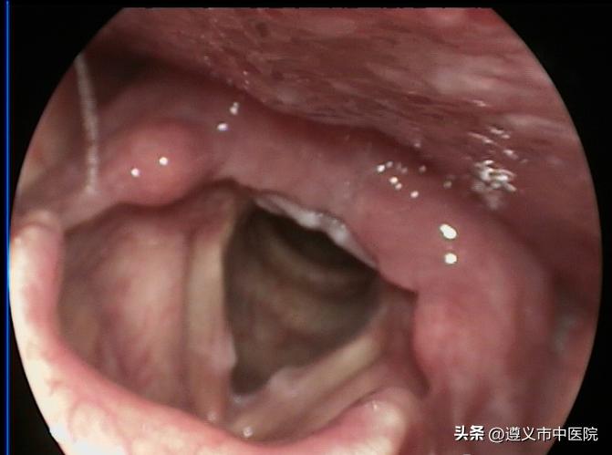 声音长期嘶哑是什么原因导致,劳累后声音就嘶哑是什么原因