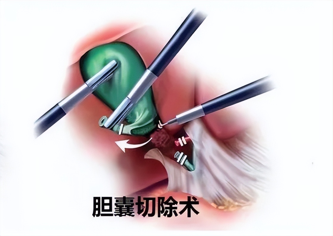 急性胆囊炎发作的原因有哪些,急性胆囊炎的症状及治疗都有哪些