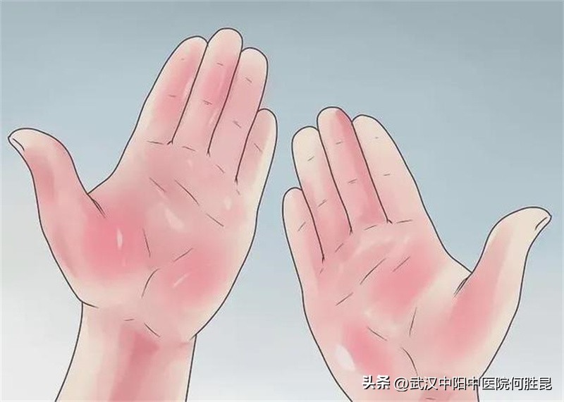 手掌长了一块癣发痒开裂,手掌起癣变成硬皮还痒怎么治