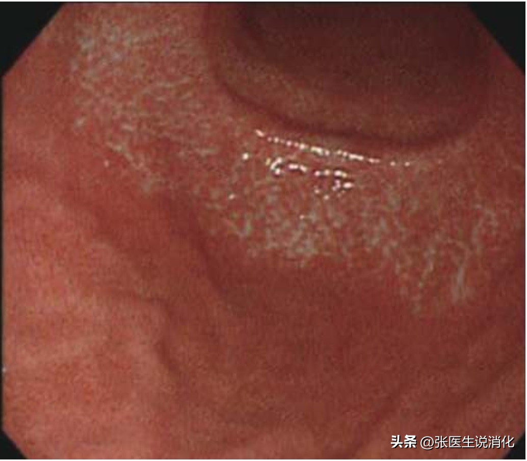 萎缩性胃炎c1是什么原因造成的,慢性萎缩性胃炎c1和c2哪个严重