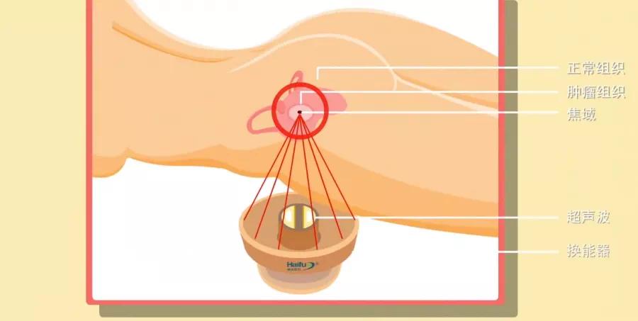 海扶刀治疗子宫肌瘤大小范围,海扶刀真的能消除子宫肌瘤吗