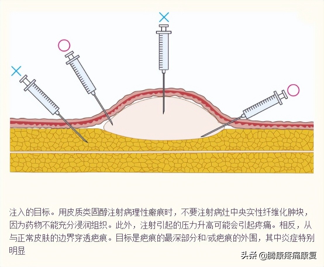 皮质类固醇贴剂治疗瘢痕疙瘩,类固醇激素治疗疤痕增生