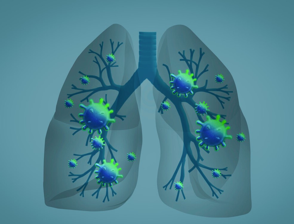 肺部神经内分泌肿瘤怎么治疗,肺大细胞神经内分泌癌2b属于几期