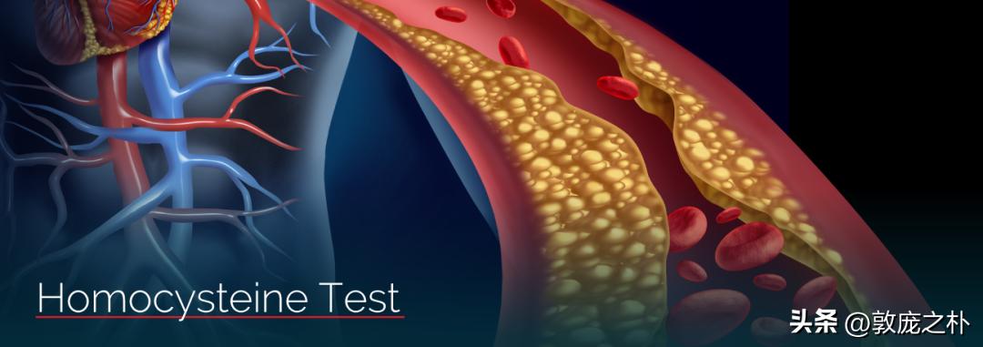 血液检验同型半胱氨酸高怎么回事 (高同型半胱氨酸血症算血液异常不)