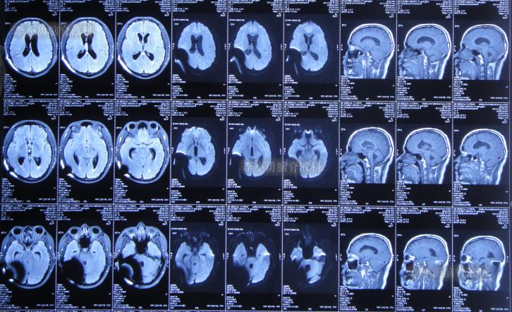 脑积水三脑室造瘘多久能恢复,脑囊虫手术后脑积水