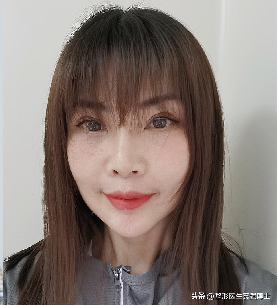 做大拉皮真的显年轻几岁吗,北京做大拉皮前后对比照片图文