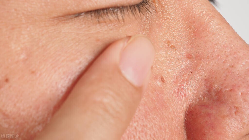 疣与HPV的前生今世